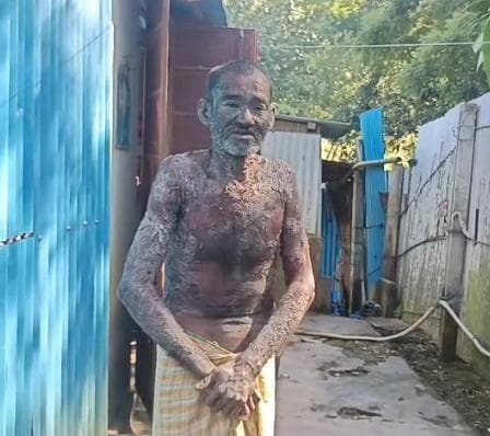  গভীর ক্ষত ও অসহ্য যন্ত্রণা নিয়ে প্রায় ঘরবন্দি কাঞ্চনমালার নিত্য লাল পাল!